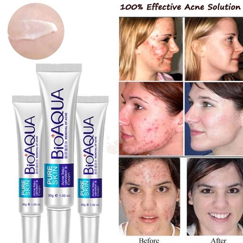 Bioaqua Acne Treatment Blackhead Removal Anti Acne Cream Oil Control Shrink Pores Acne Scar Face Care